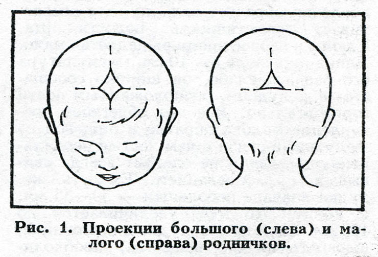 Где на голове родничок. Форма малого родничка у новорожденного. Родничок и темечко у новорожденных. Большой и малый Родничок у новорожденного. Норма темечки у младенцев.