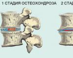 Грудной остеохондроз — симптомы и лечение